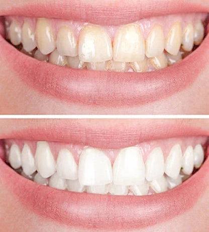 Viya White Dental Whitening - VALENTINES PROMOTION (50% OFF)