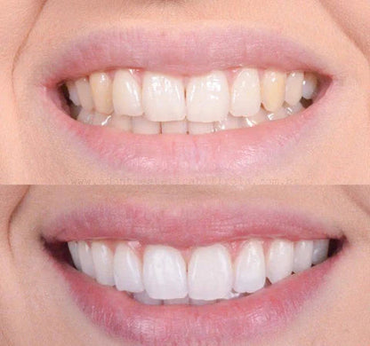 Viya White Dental Whitening - VALENTINES PROMOTION (50% OFF)