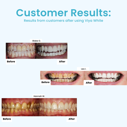 Viya White Dental Whitening - VALENTINES PROMOTION (50% OFF)